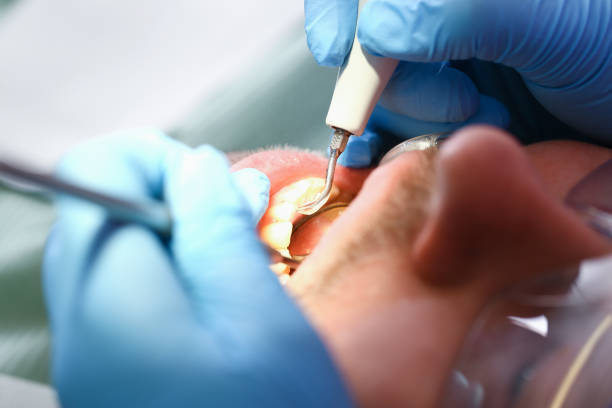 Best Emergency Tooth Extraction in Gratton, VA