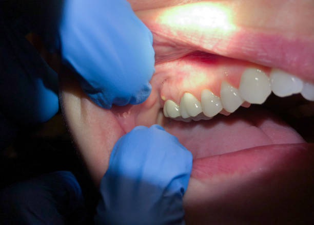 Best Emergency Broken Tooth Repair in Gratton, VA